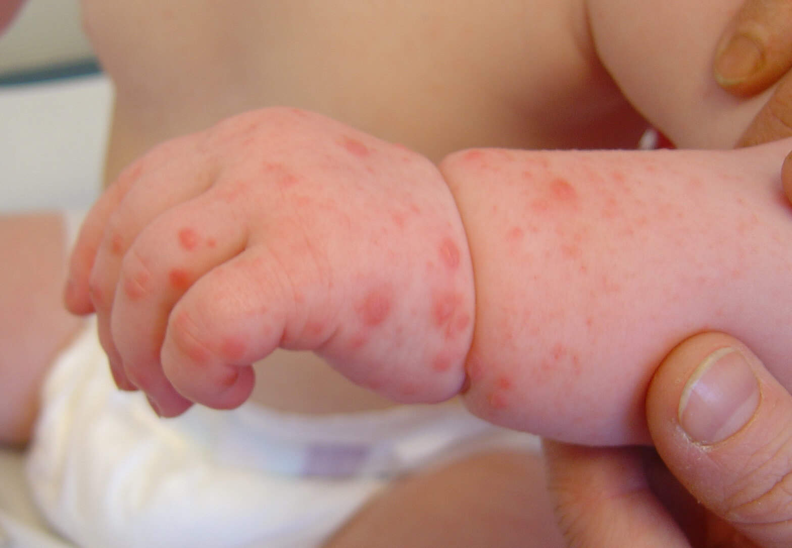 Hand Foot and Mouth Disease Picture Image