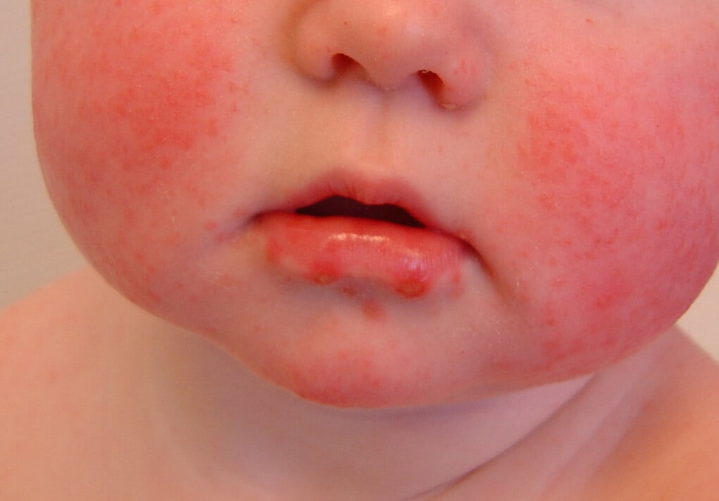Hand-Foot-and-Mouth Disease-Topic Overview - WebMD