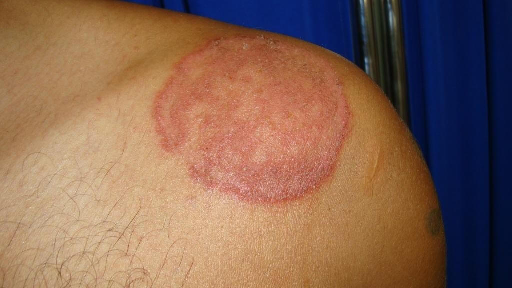 ringworm images