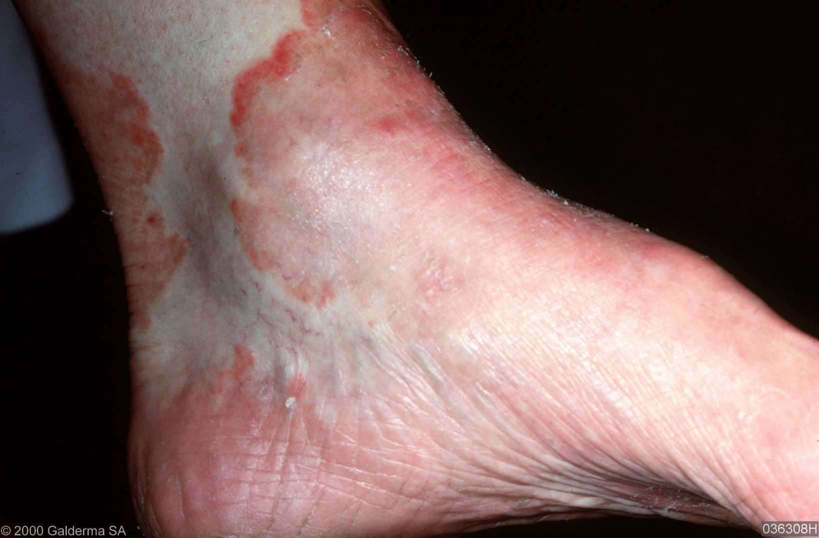 Could you get a strain of the herpes virus on your feet ...