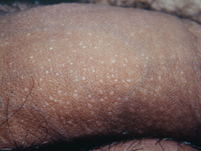 lichen nitidus penis