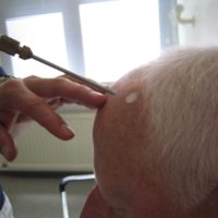 Cryotherapie