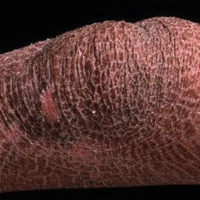 Ichthyosis