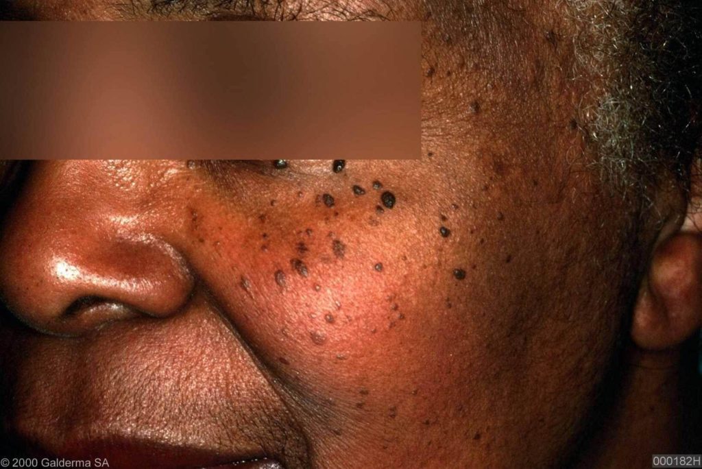 skinsight - Dermatosis Papulosa Nigra