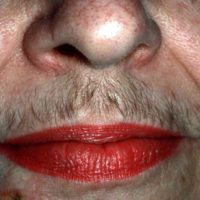 Hirsutisme Hirsutisme
