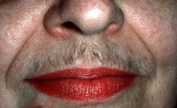 Hirsutisme