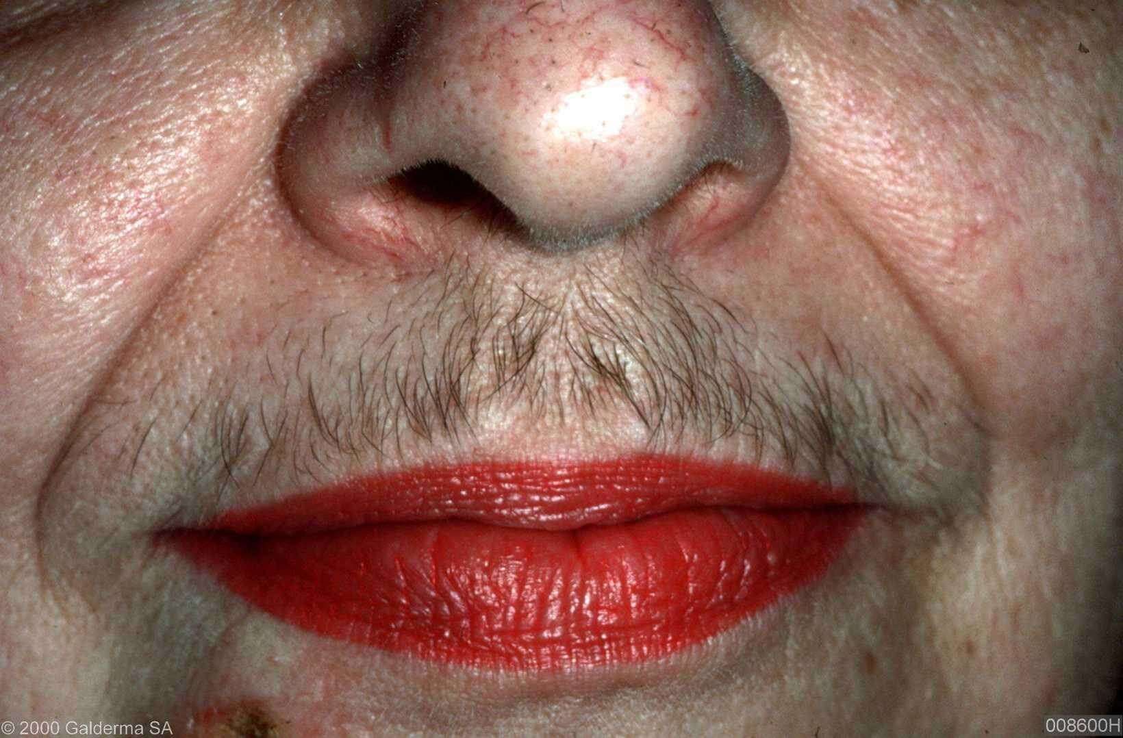 Juliette F r Hirsutismus Hirsutismus Und Hypertrichose ZOLQXW Juliette F r Hirsutismus Hirsutismus Und Hypertrichose ZOLQXW