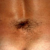 Hypertrichosis