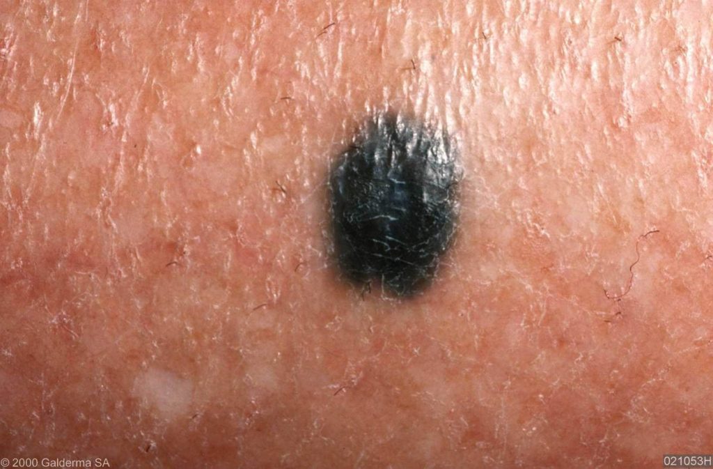 Blue nevus of the nail - wide 7