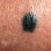 Blue nevus