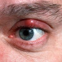 Chalazion