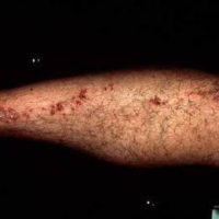 Porokeratose, Lineair