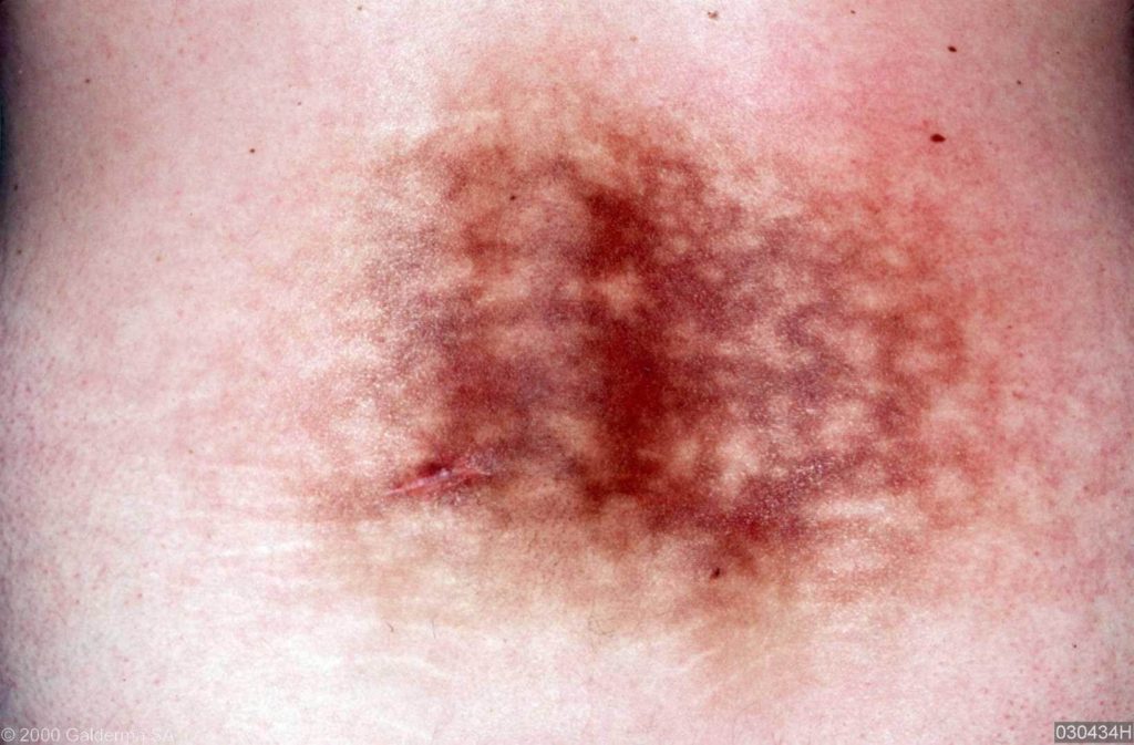 Erythema Ab Igne - American Osteopathic College of ...