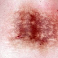 Erythema ab igne