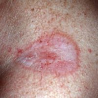 Lichen sclerosus