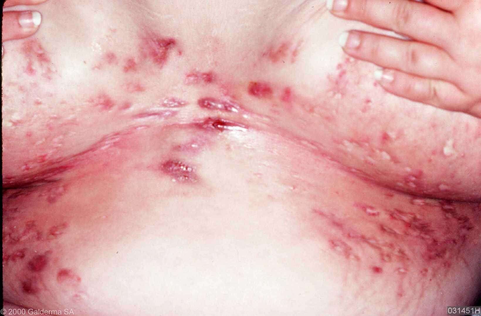 Hidradenitis suppurativa | American Academy of Dermatology