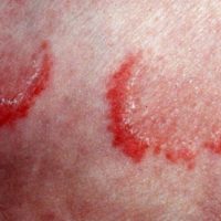 Erythema annulare centrifuguum