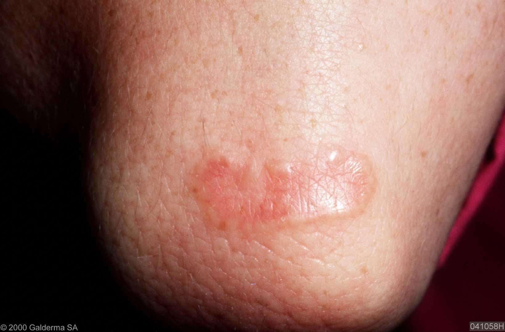 granuloma annulare pictures