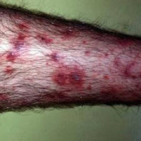 Henoch Schonlein purpura