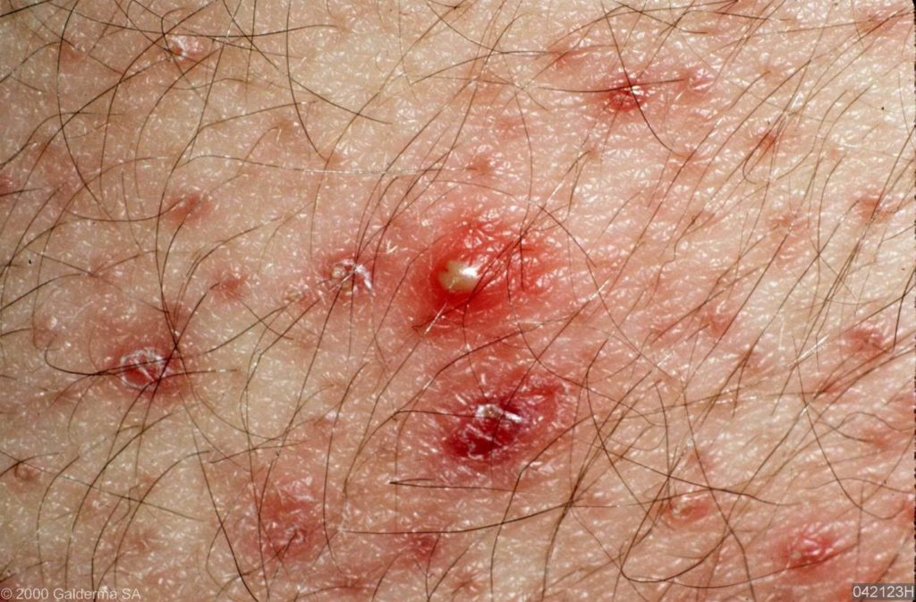 Folliculitis - Huidarts.com, ontstoken haarzakje, pustel, puist, geen acne, jeuk, rode bultjes, ontsteking