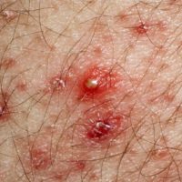 Folliculitis