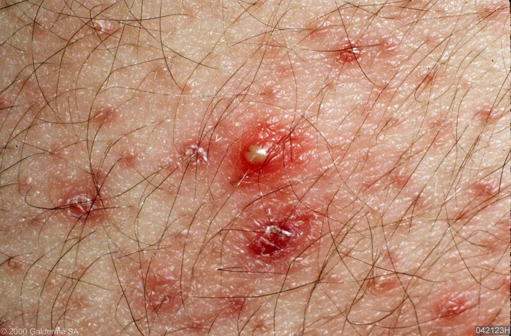 Folliculitis Op Benen GISTPUISTJES Uitleg Door De Dermatoloog Info