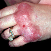 Erythema Elevatum Diutinum