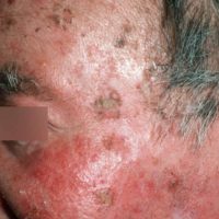 Actinische keratose in het gezicht