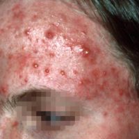 acne voorhoofd