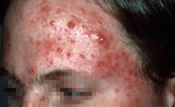 acne voorhoofd