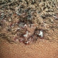 Acne keloidalis