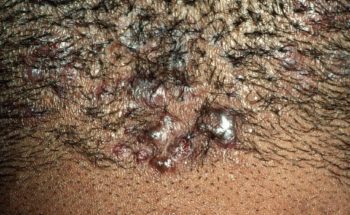 Acne keloidalis