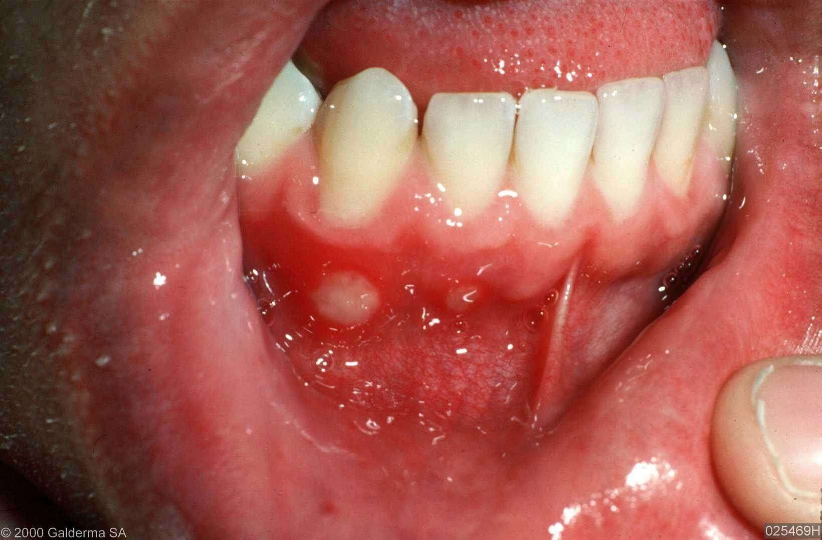 What Is the Best Treatment for Oral Herpes? - The GoodRx ...