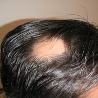 Alopecia Areata - Titel