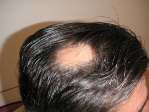 Alopecia Areata - Titel