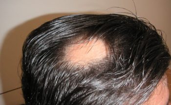 Alopecia Areata - Titel