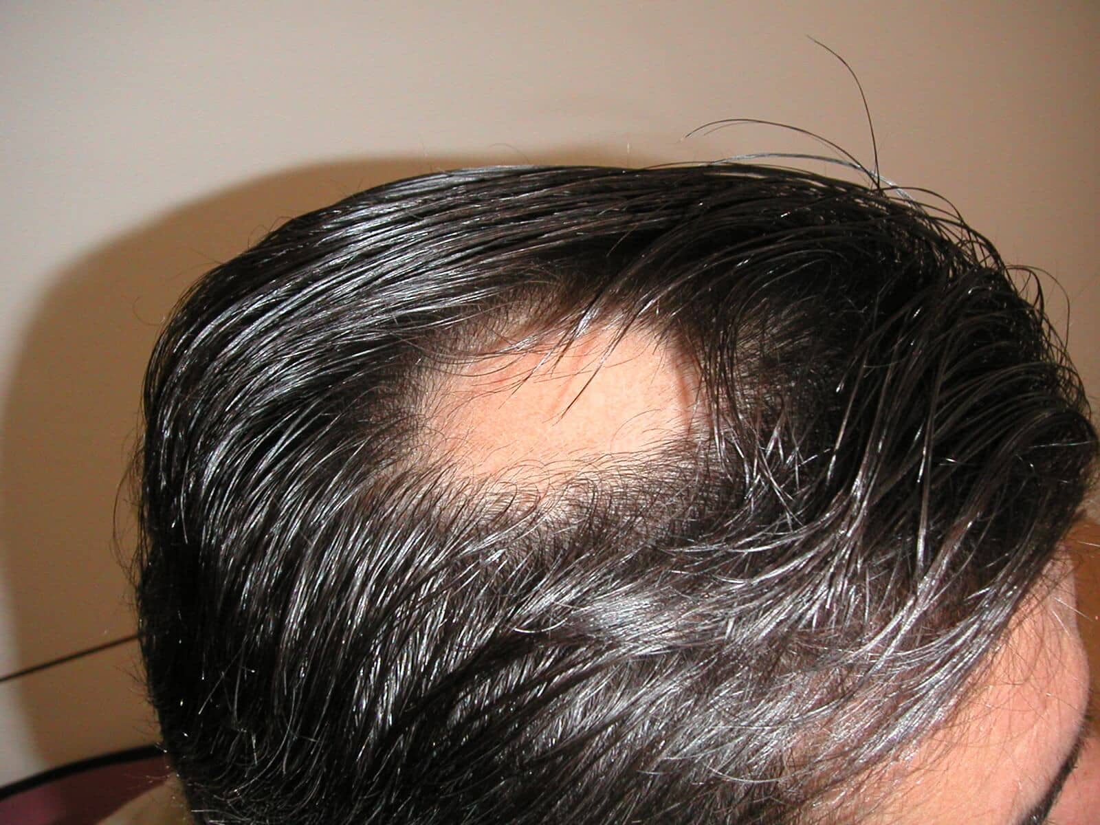Op de grond Emulatie Stuiteren Alopecia areata - Huidarts.com