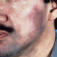 Ashy Dermatosis gezicht Ashy Dermatosis gezicht