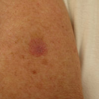 Benigne LIchenoide keratose-Titel