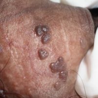 Bowenoide papulosis