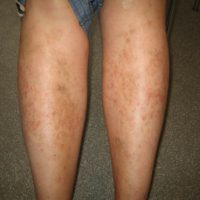 Capillaritis