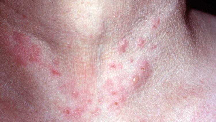 Dermatitis herpetiformis / Ziekte van Dühring