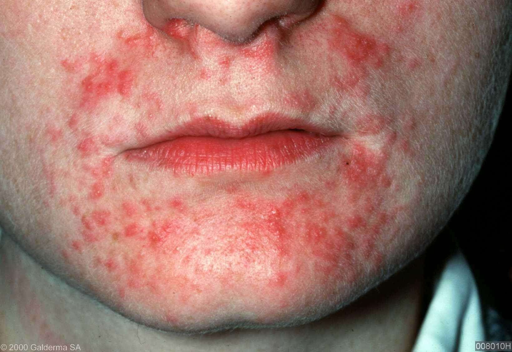 Dermatite P riorale Localisation EYONM