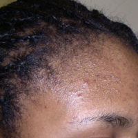 donkere littekens na acne