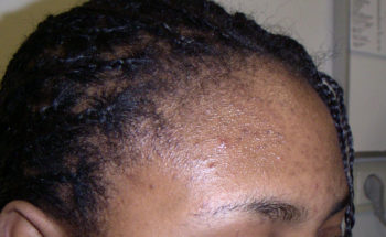 donkere littekens na acne