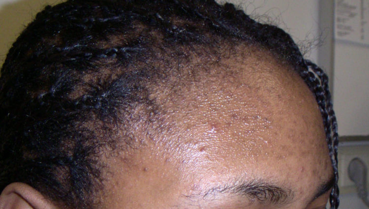 Donkere littekens / Post-inflammatoire hyperpigmentatie