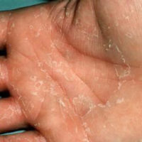 Dyshidrosis lamellosa sicca