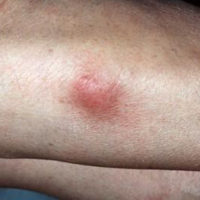 Erythema Nodosum-Titel