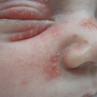 Erythema Toxicum gezicht-Titel