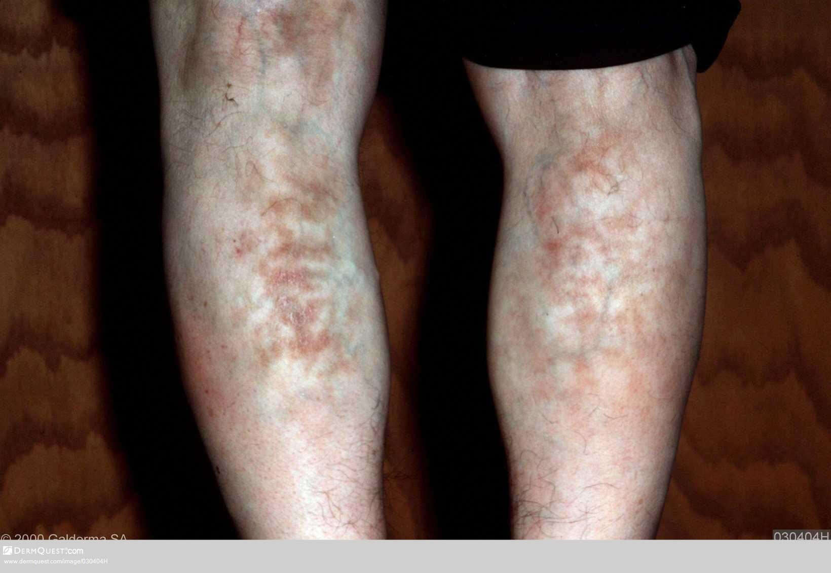 Erythema Ab Igne - Diseases & Conditions - Medscape Reference